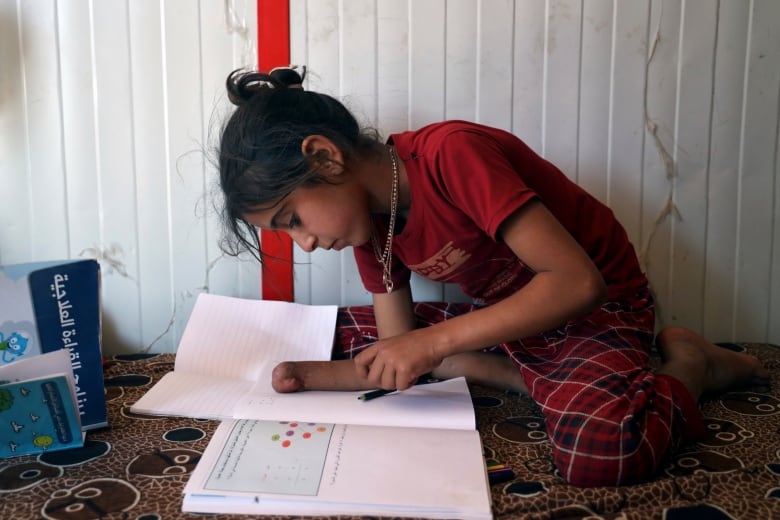 A child missing their right hand leans over a school workbook.