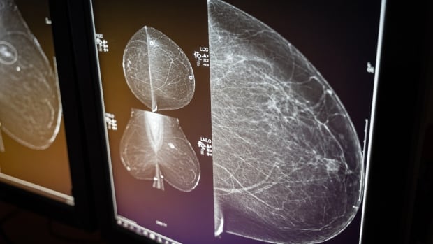 mammogram.jpg