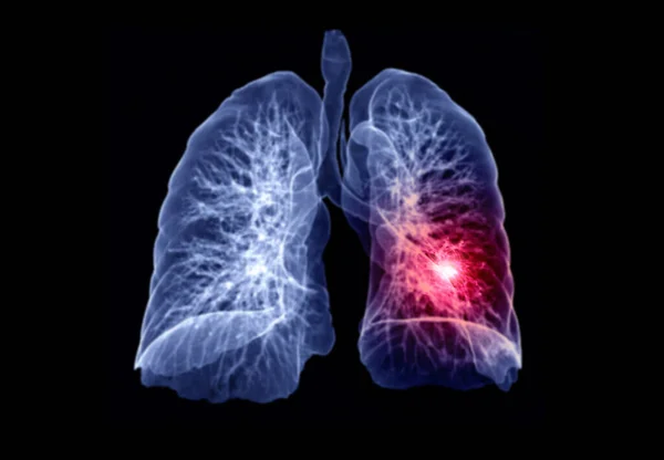 Non-Smokers’ Lung Cancer Now a Top Five Global Cancer Killer