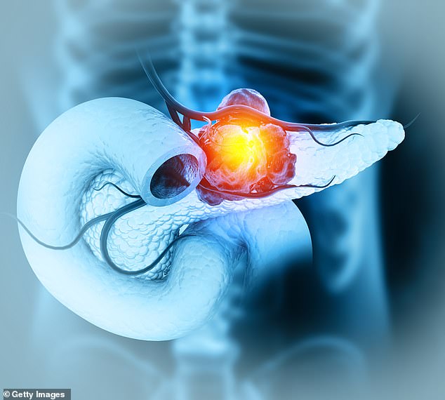 The seriousness of prostate cancer is determined by its Gleason score (what the cancer cells look like in relation to normal cells)