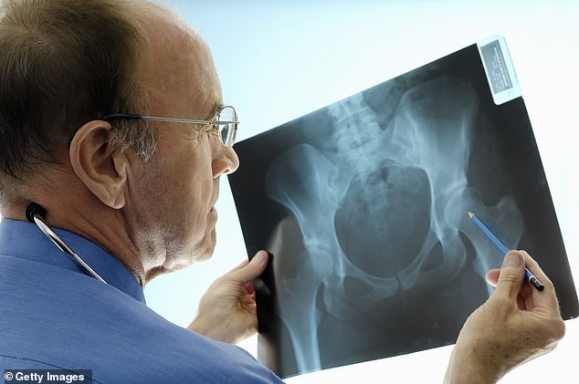 It’s not just ‘old ladies’ – men’s bones can crumble too… LBC presenter Iain Dale had no idea he could get osteoporosis before he broke his hip in an agonising fall