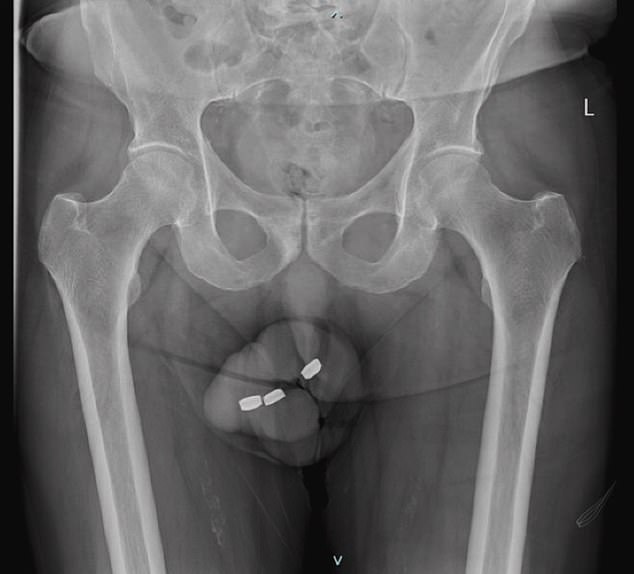 Man, 73, is left with horrifying penile ‘necrosis’ after getting three 1cm-wide batteries stuck in his urethra