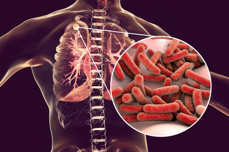 Secondary Tuberculosis Infection Anatomy Image