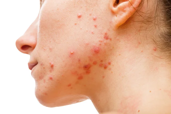 How do you know you have fungal acne? Causes, symptoms and treatment