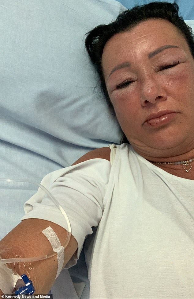 Ms Egale woke up on the second day of her family holiday last April with a swollen face and struggling to breathe. Hospital staff acted quickly and treated her with a high dose of steroids and discharged later that day. But she said it took more than a week for her symptoms to subside