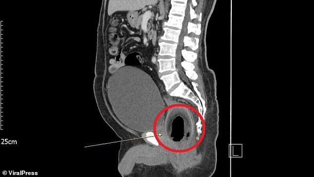 Writing in the British Journal of Surgery , medics claimed he had been unable to urinate and complained of severe abdominal pain. Upon examination CT scans showed the fruit was lodged in his rectum compressing the urethra and preventing him from urinating