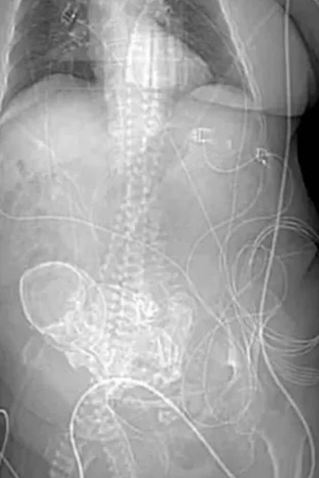 Medics had detected the calcified foetus, called a lithopedion, during a scan after Daniela complained of stomach pains