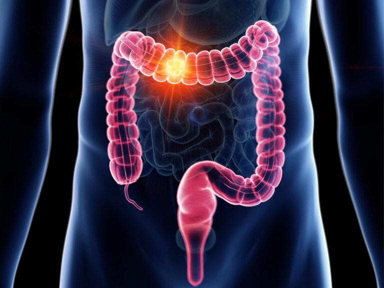 At-Home Colon Cancer Test Proves Just As Effective as a Colonoscopy