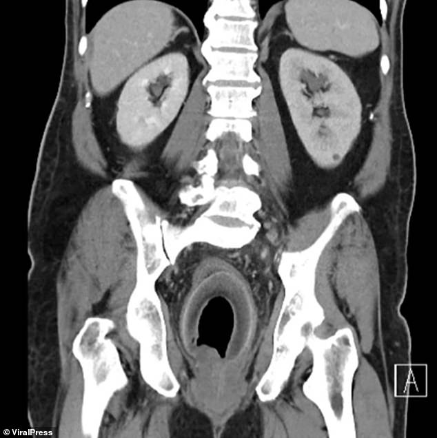 Taiwanese man, 56, needs COCONUT removed from his rectum