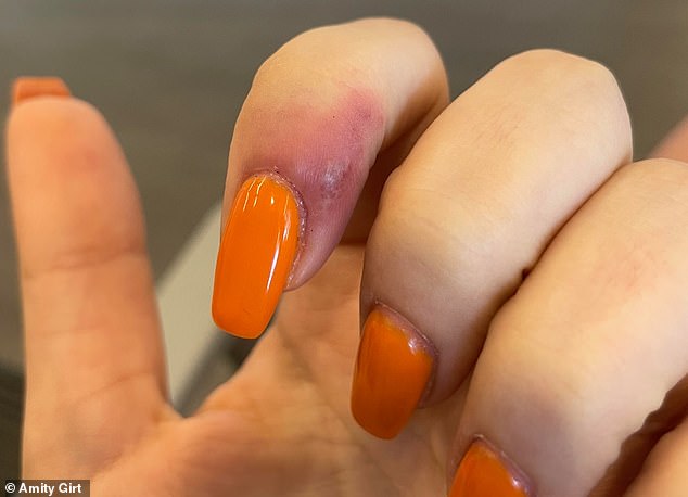 The manicure from hell: Woman, 23, in Oregon sues nail salon for $1.75million claiming treatment gave her HERPES