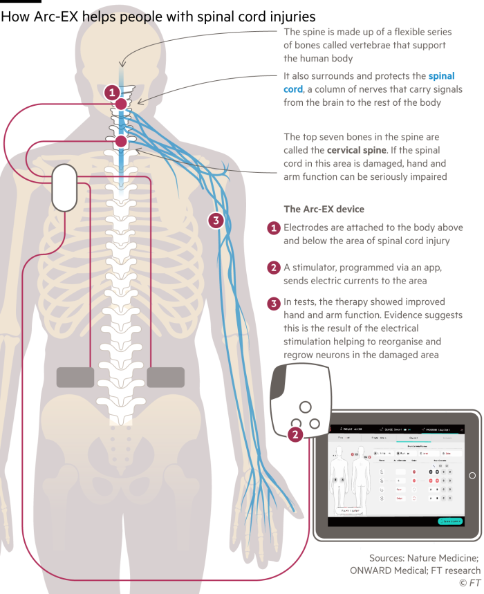 Diagram explaining a new technology for treating spinal cord injuries with electrical stimulation