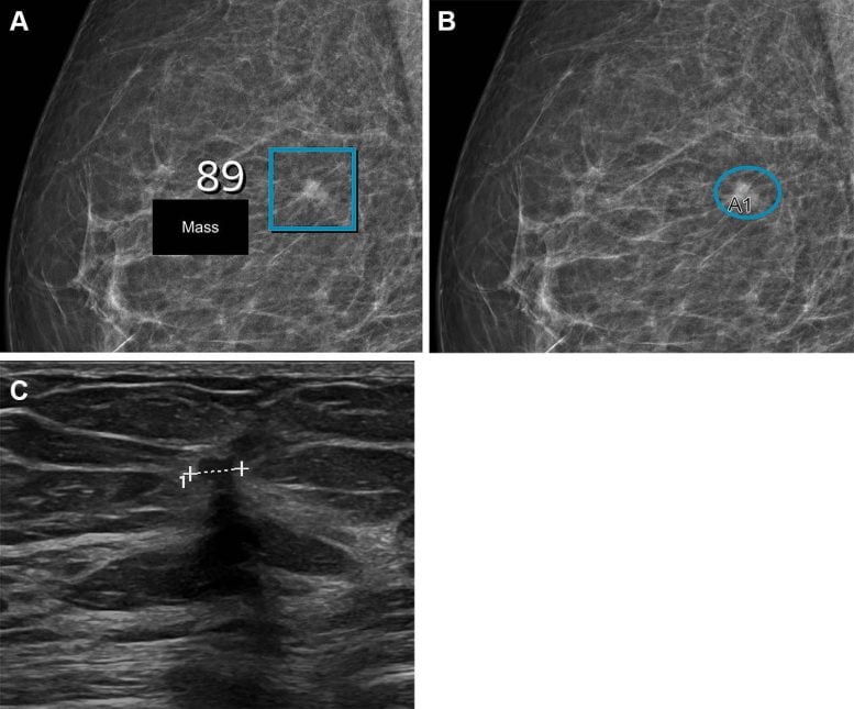 Breast Imaging Reporting and Data System Density of 2