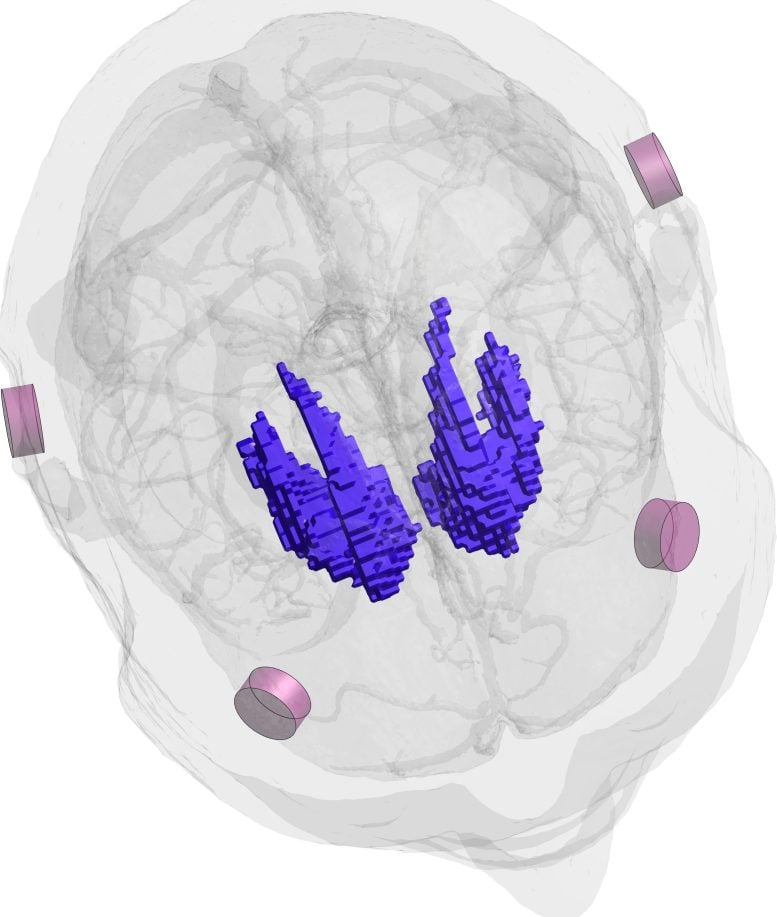 Non Invasive Stimulation of the Striatum Square