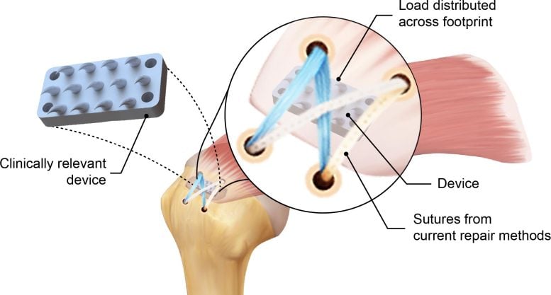 Python Tooth Inspired Rotator Cuff Repair