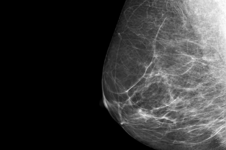 AI Transforms Breast Cancer Screenings With Sharper Accuracy