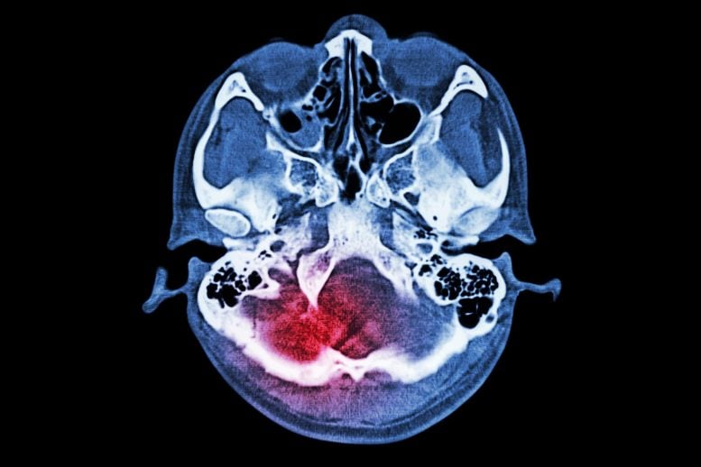 Brain Injury Stroke