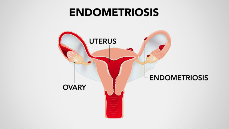 A graphic of a uterus with Fallopian tubes and ovaries attached.