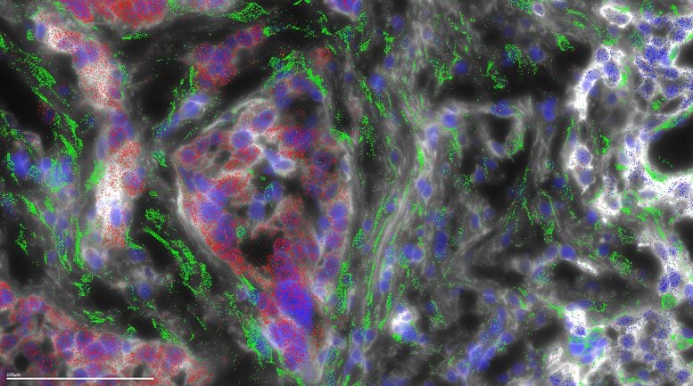 FLC Tumor Cells