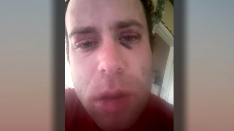 A close-up photo of a man with a bruised eye and swollen face. 