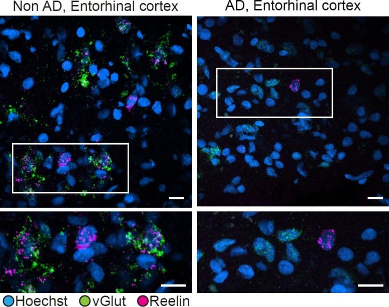 Reelin Expression Alzheimer’s Disease