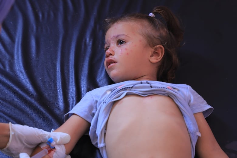 A little girl in a purple shirt gets an iv drip in her arm and has pimples on her face