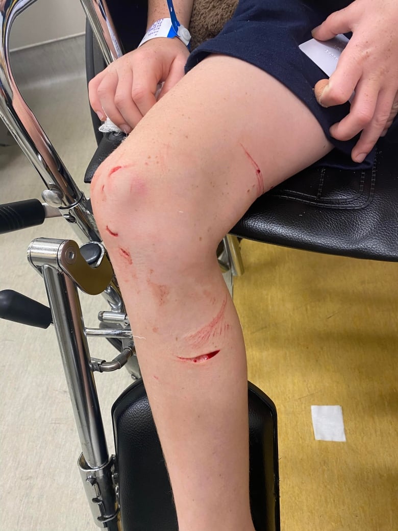 A boy's leg is deeply lacerated and scraped. 