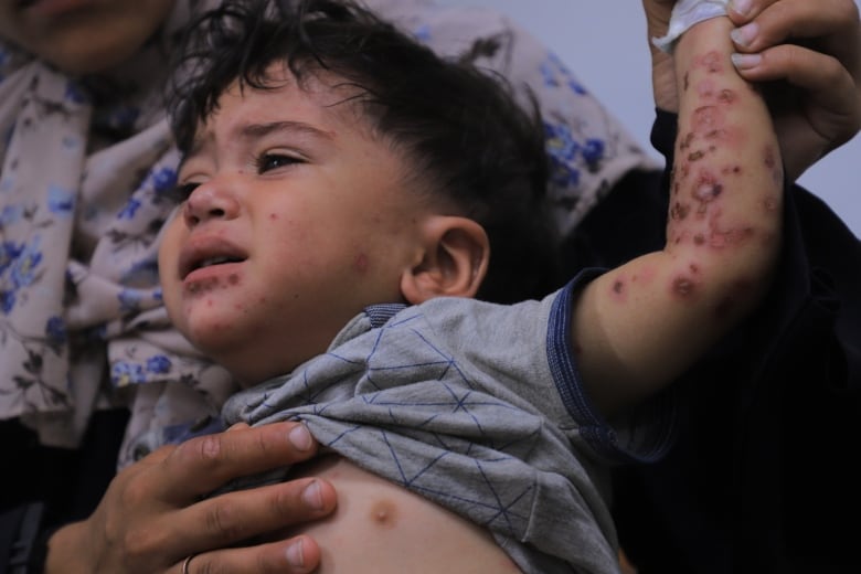 A little boy in a blue shirt lifts his arm and shows a skin rash