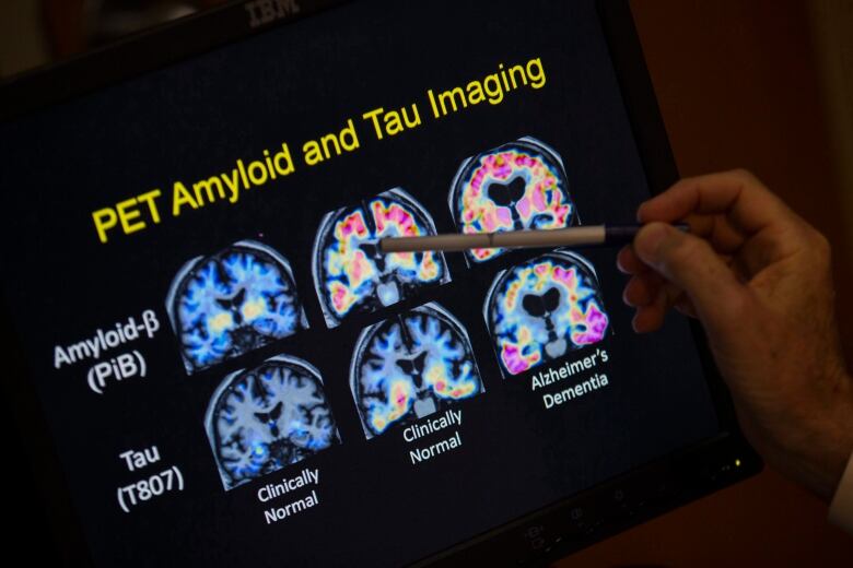 A U.S. doctor points to PET scan results that are part of a study on Alzheimer’s disease in 2015. Doctors are eyeing blood tests to help them diagnose Alzheimer’s disease faster and more accurately but they don't all work equally well. 