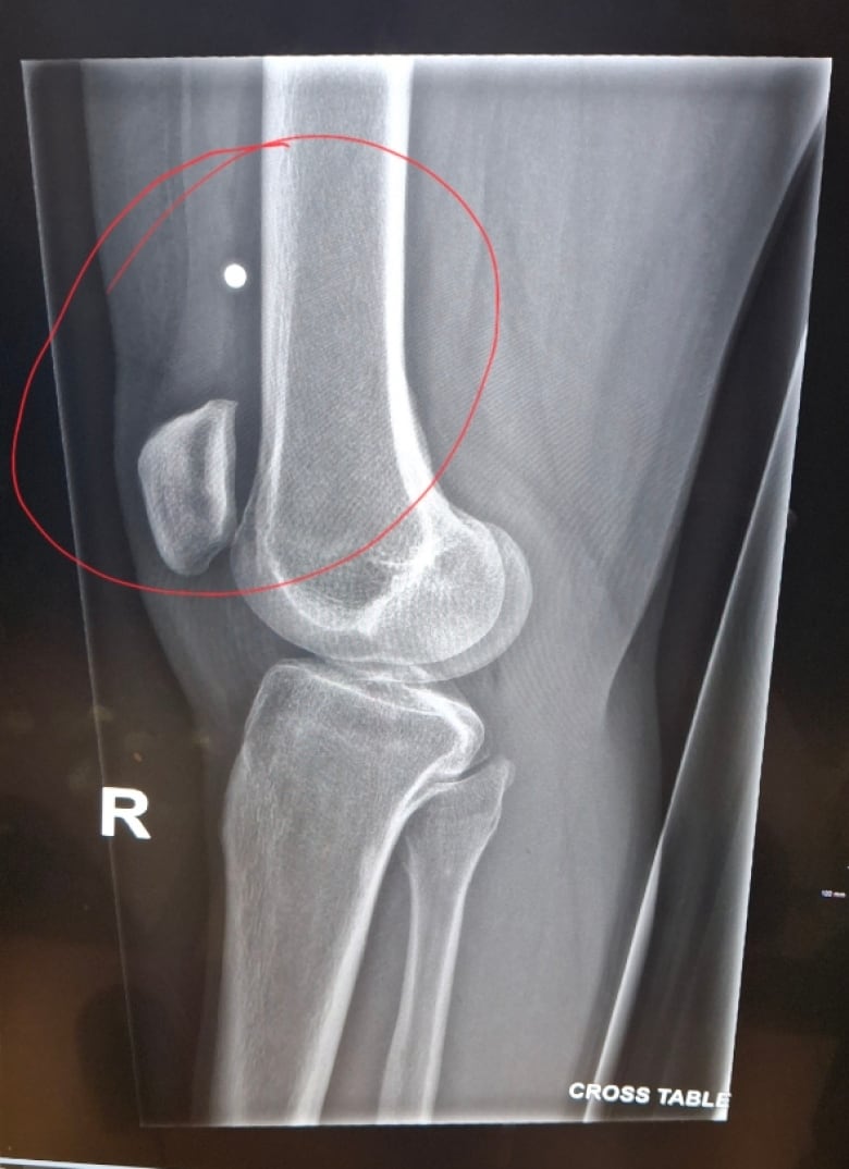 An X-ray of a knee showing an abnormal circle in the muscle. 