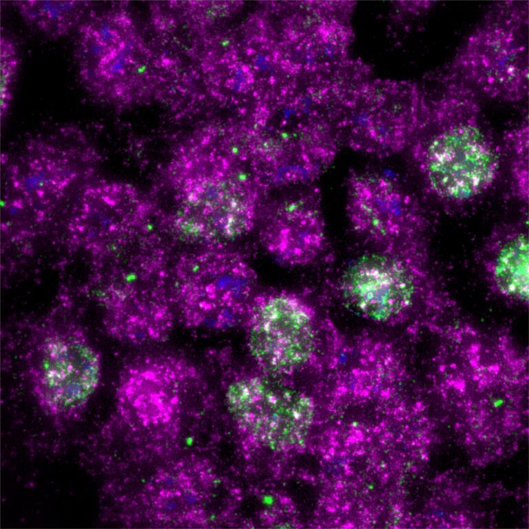 UV radiation damage leads to ribosome roadblocks, causing early skin cell death