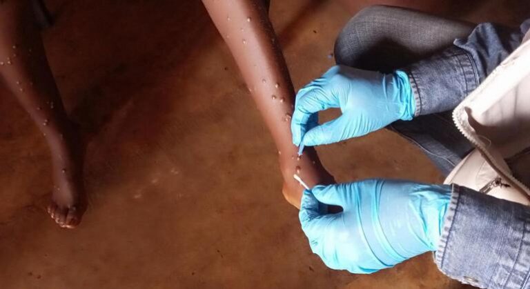 Mpox: What you need to know about the latest public health emergency