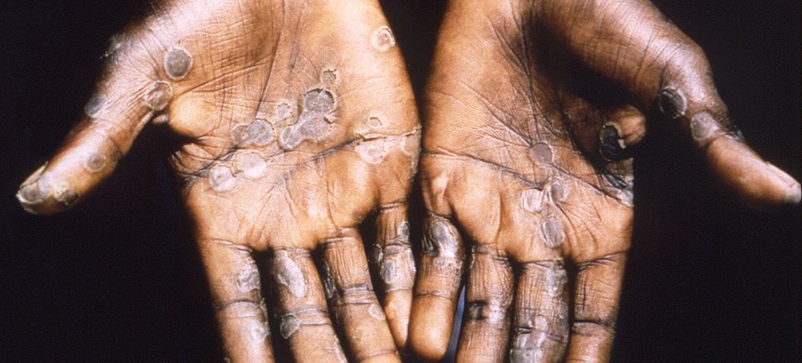 Mpox lesions often appear on the palms of hands. (file)