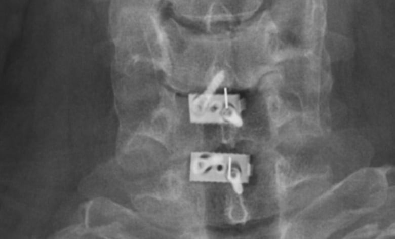 An X-ray of Scott Snow's neck after having surgery on his cervical spine for injuries