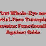 First Whole-Eye and Partial-Face Transplant Sustains Functionality Against Odds