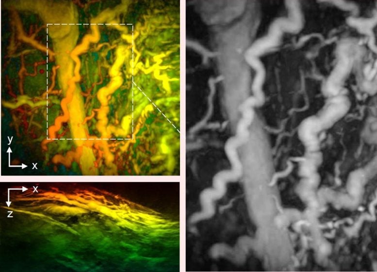 Disease Captured by Hand-Held 3D Photoacoustic Scanner