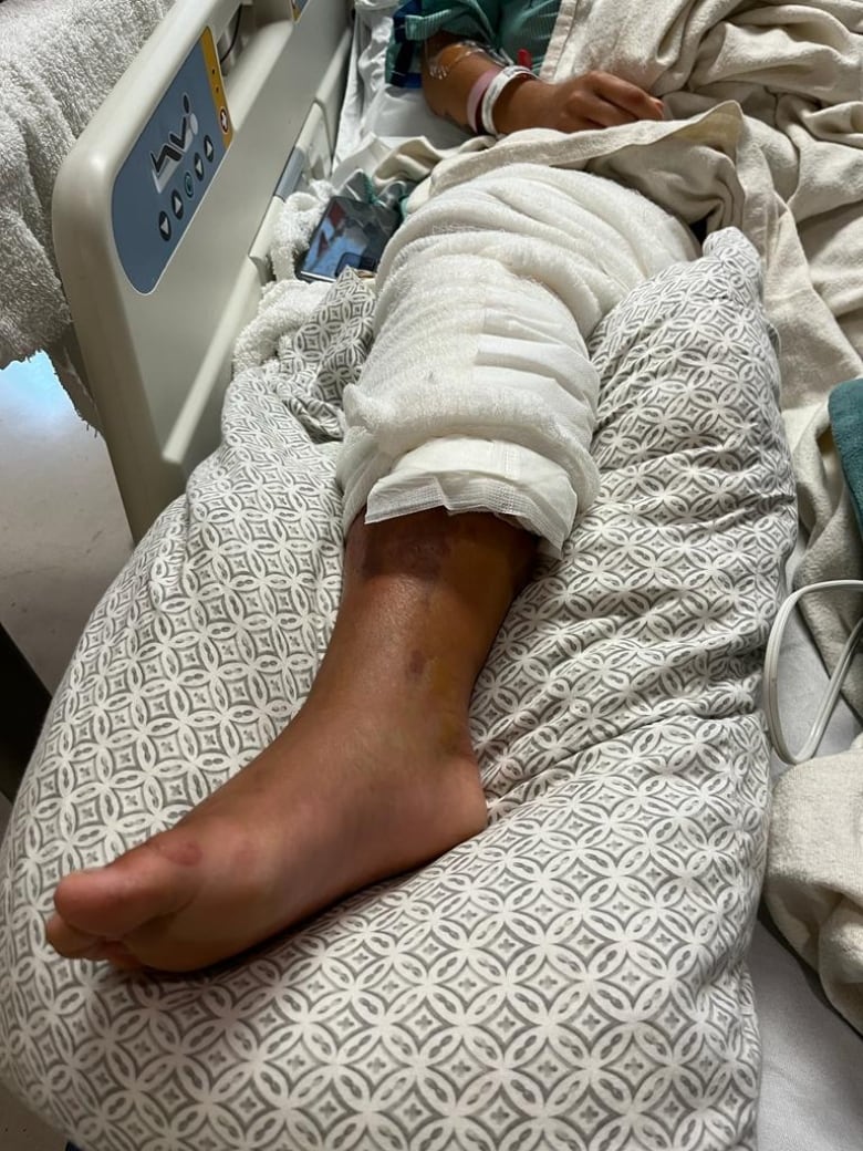 A leg of a patient in hospital with iGAS infection.