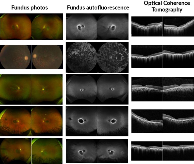 Ophthalmic Imaging for the Probands Exhibiting Variable Forms of Retinal Dystrophy