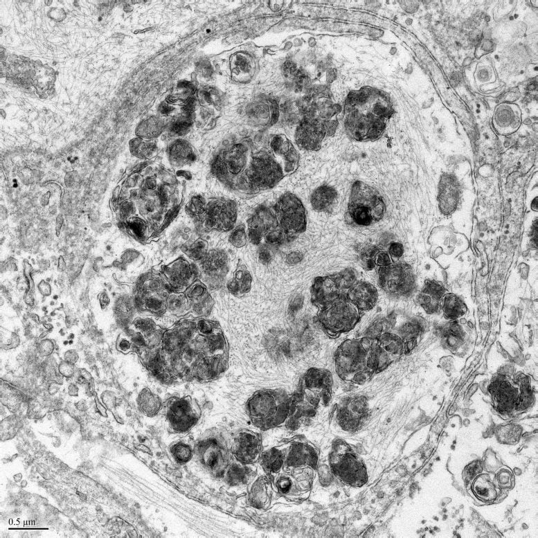 Development of Lewy Bodies