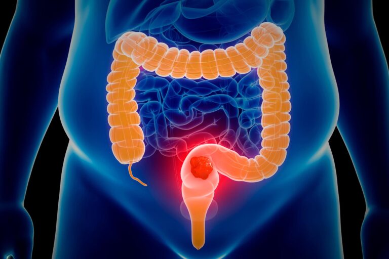 Stanford Study Reveals Blood Tests for Colon Cancer Fall Short of Colonoscopy Effectiveness