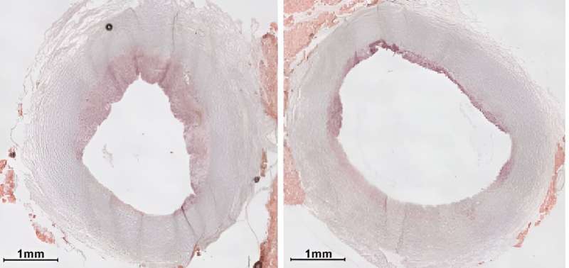 New nanotherapy targets artery inflammation in cardiovascular disease