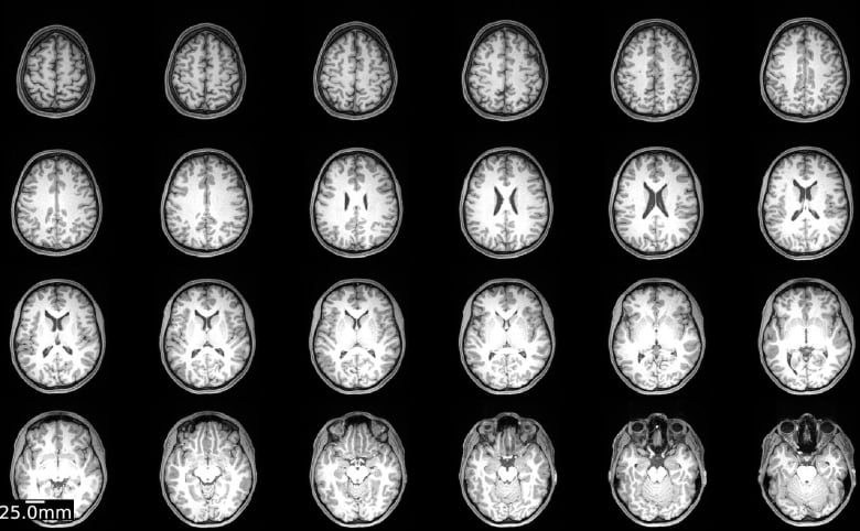 Black and white images showing a human brain from various angles