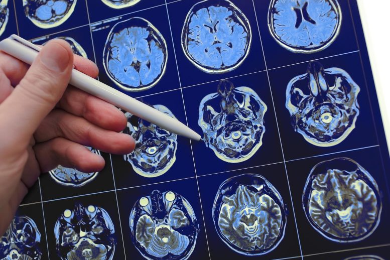 MRI Brain Scan Pen