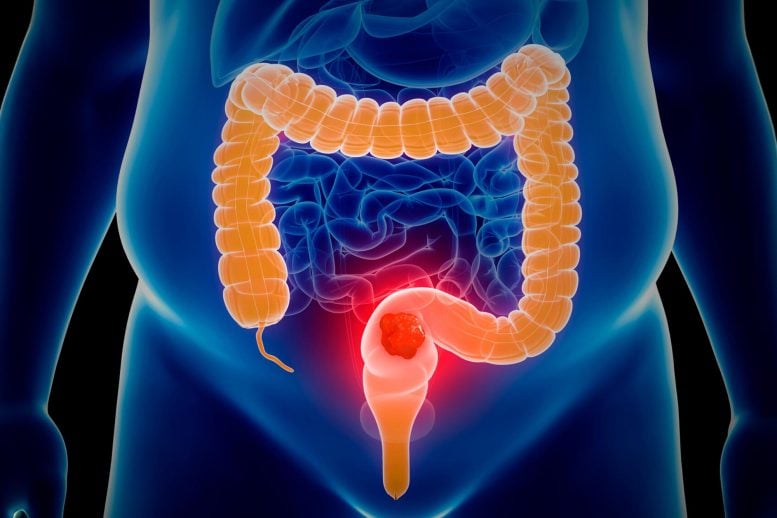 Colon Cancer Anatomy Illustration Close Up