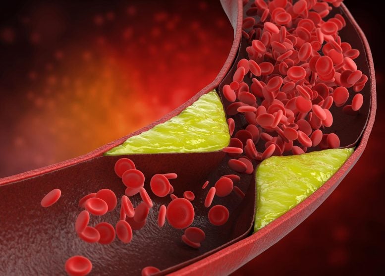 Atherosclerosis Plaque Blood Vessel