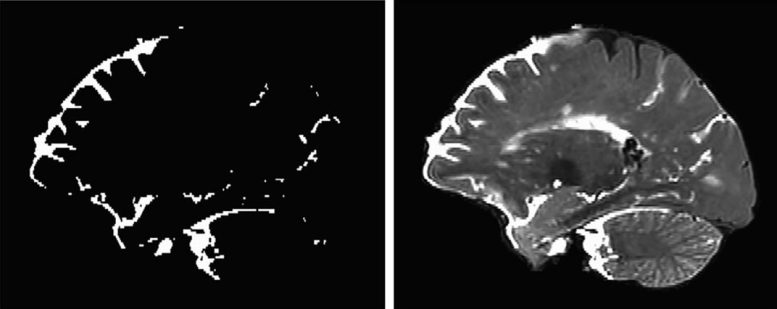 Perivascular Spaces in Human Brain