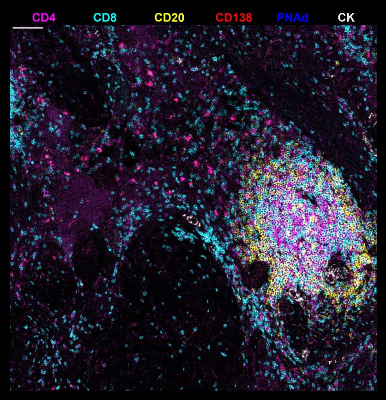 Tertiary Lymphoid Structure