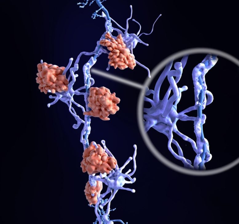 Multiple Sclerosis Neuron